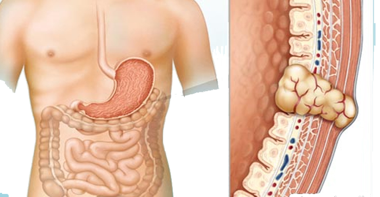 O que saber sobre tumores estromais gastrointestinais (GISTs)