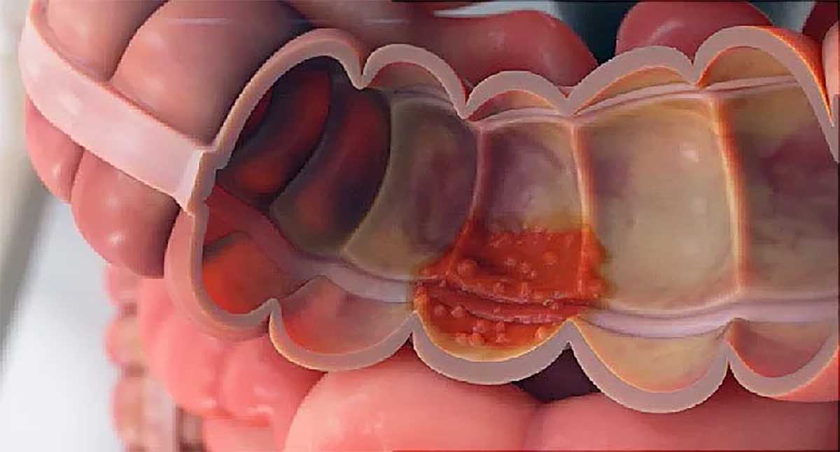 Os Riscos Da Colite Ulcerativa N O Tratada Pronto Gastro   Ulcerativa 