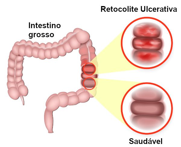 Retocolite Ulcerativa: Causas, Sintomas e Tratamentos