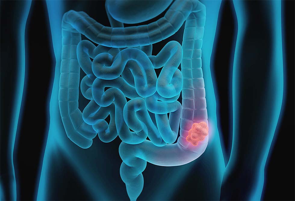 Obstrução Intestinal: Causas, Riscos e Tratamentos