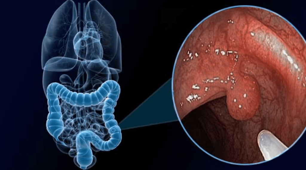 Pólipos Adenomatosos: Prevenção e Importância do Rastreamento