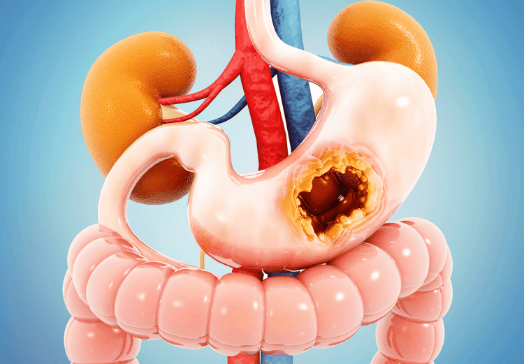 TUMORES GASTROINTESTINAIS COMUNS: O QUE VOCÊ PRECISA SABER