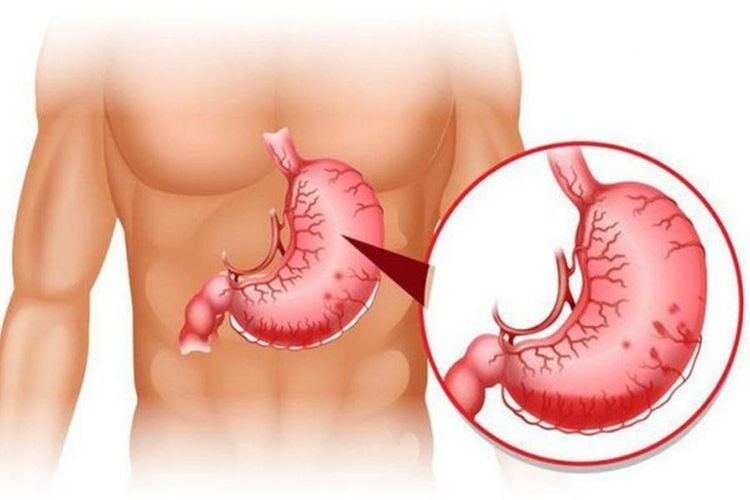 VARIZES GÁSTRICAS: O QUE SÃO, SINTOMAS E TRATAMENTOS